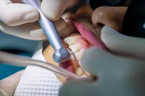 Dentist preparing tooth for crown with high speed dental handpiece Stock Photos