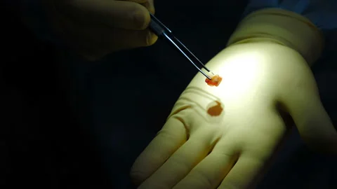 Dentist in protective gloves holds wrenched wisdom teeth. Doctor examines Stock Footage 153804003