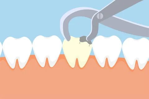 Dentist pulling out a dead tooth with equipment. Dental care activities with  Illustrazione stock