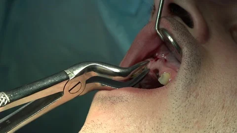 The dentist pulls out a tooth Stock Footage 87179949