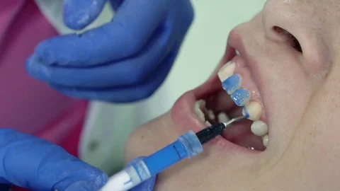 Dentist puts base for placing dental veneers Stock Footage 75691563