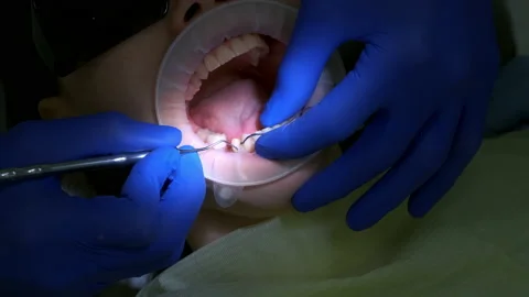 Dentist puts thread to stop the bleeding between the tooth and gum of patient. Stock Footage 168127030