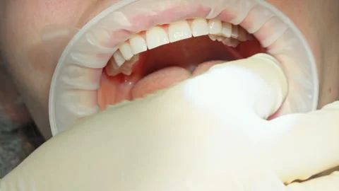 A dentist screwing the first titanium part of a dental implant into a jaw Stock Footage 342079792
