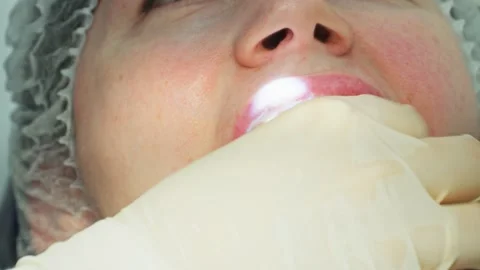 A dentist screwing titanium part of a dental implant into a jaw with a driver 스톡 동영상 342079679