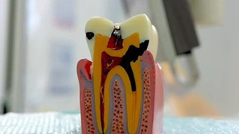 The dentist shows how a broken teeth with caries, a lesson Stock Footage 104263847