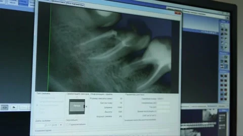Dentist shows the X-ray image on the monitor of the tooth of the patient Stock Footage 66692773