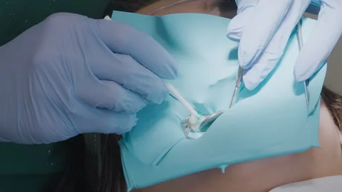 Dentist spreading blue acid etchant gel on child tooth with microbrush Stock Footage 331239566