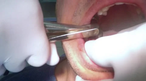Dentist tooth extraction removal closeup Video stock 61744487