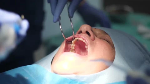 Dentist Touching Up Tooth Implant Stock Footage 148498614