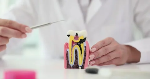 Dentist uses anatomical model of tooth to show signs of decay Stock Footage 317167636