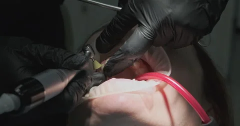 Dentist uses a saliva ejector. Continues grinding teeth. Close-up of the patient Stock Footage 243639939