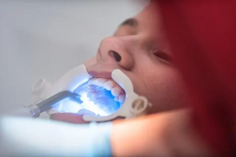 The dentist uses an ultraviolet lamp while fitting the girl with braces Stock Photos