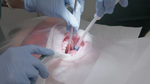 Dentist using 3-way syringe and assistant using suction saliva ejector Video stock 332300110