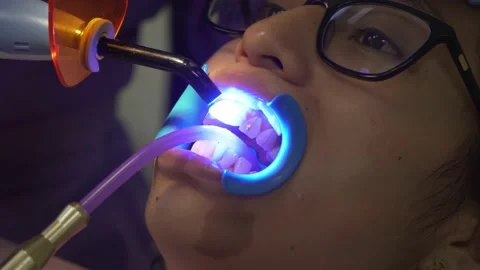 Dentist using dental curing light before doing orthodontia to a asian girl Video stock 187691165