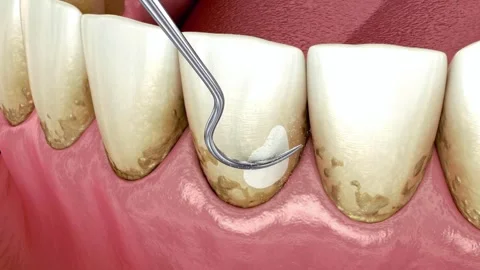 Dentist Using Dental Pick to Remove Plaque and Tartar Stock Footage 327669914