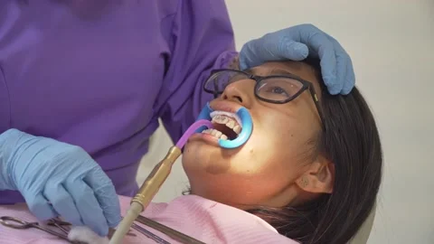 Dentist using her tools, brakets, hooks, arch wire and elastic tie in a girl Stock Footage 187691308