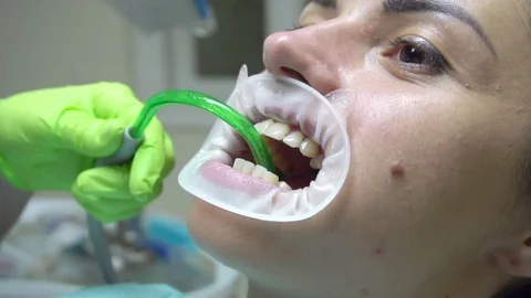 Dentist using saliva ejector or dental pump to evacuate saliva. Young woman with Vídeo Stock 74836117