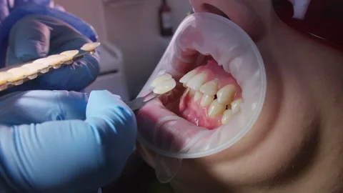 Dentist Using Shade Guide for Tooth Color Matching in Clinic 動画素材 296719495