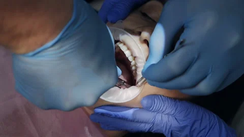 Dentist using surgical pliers to extract a tooth in the dental office. Extracted Stock Footage 159449738