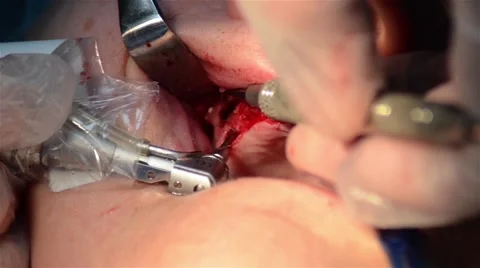 Dentist which pierce the patient s jaw to make a dental implant Stock Footage 60799005