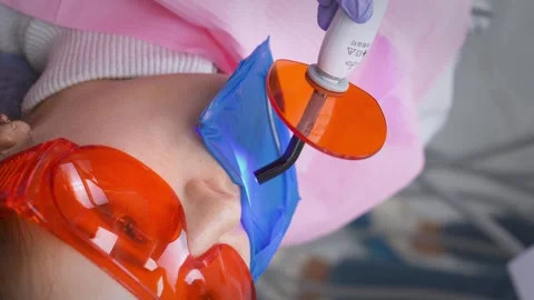 Dentist working with dental polymerization UV lamp in oral cavity Stock Footage 258680608