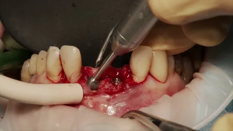 The dentist works with a drill Stock Footage 160607762