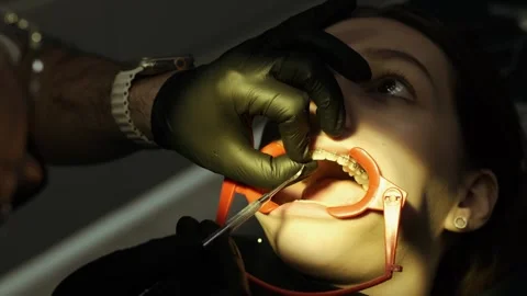 Dentist young man removes braces from the patient. Reception at the orthodontist Stock Footage 306282059
