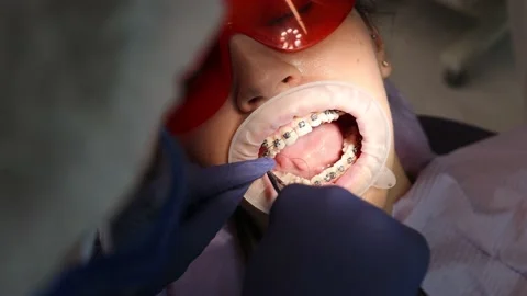 Dentistry, cheating on braces, orthodontics, the process of fixing Stock Footage 156065956