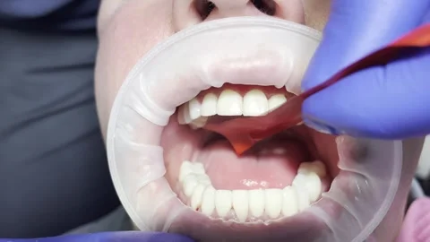 Dentistry. Checking jaw occlusion using articulating paper Stock Footage 278225458