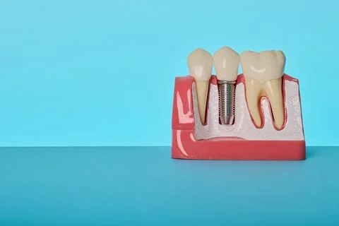 Dentistry implant model horizontal view. Prosthetic tooth restoration and d.. Stock Photos