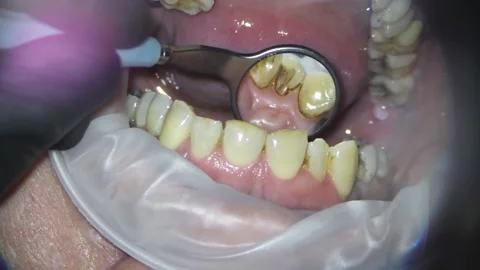 Dentistry, scanning with a microscope, examination of the inner surface of the t Stock Footage 158665056