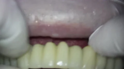Dentistry. shooting with a microscope. installation of metal-plastic teeth Vidéo 154460297