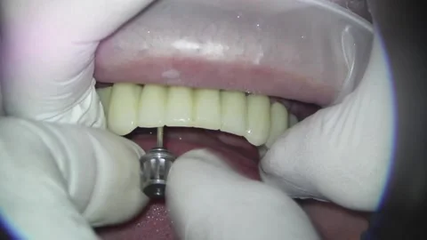 Dentistry. shooting with a microscope. installation of metal-plastic teeth Stock Footage 154460306