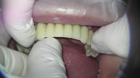 Dentistry. shooting with a microscope. installation of metal-plastic teeth Stock Footage 154460313