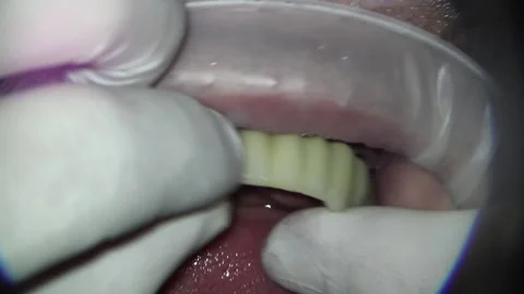 Dentistry. shooting with a microscope. installation of metal-plastic teeth Stock Footage 154460315