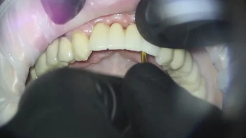 Dentistry. shooting with a microscope. installation of metal-plastic teeth Stock Footage 158665129