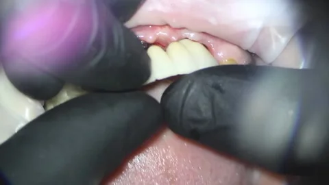 Dentistry. shooting with a microscope. installation of metal-plastic teeth Stock Footage 158665131