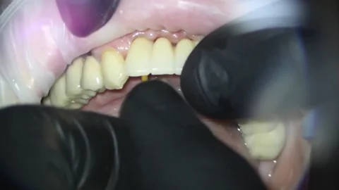 Dentistry. shooting with a microscope. installation of metal-plastic teeth Stock Footage 158665138