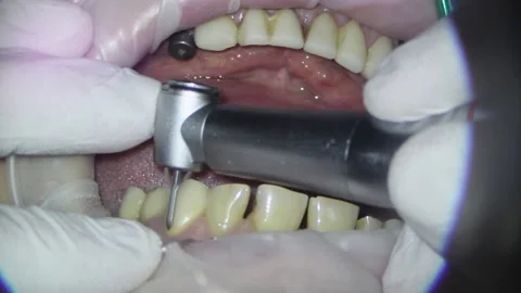 Dentistry. shooting with a microscope. removal of old fillings and treatment of Stock Footage 158543176