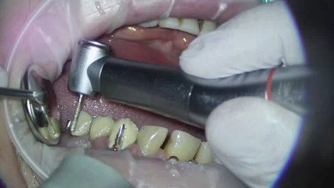 Dentistry. shooting with a microscope. removal of old fillings and treatment of Stock Footage 158543359