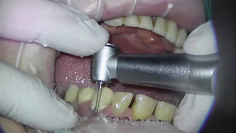 Dentistry. shooting with a microscope. removal of old fillings and treatment of Stock Footage 158543402