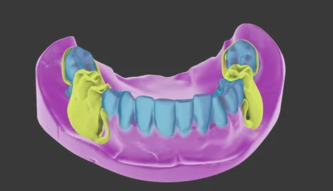 Dentistry Technical Program Applying Artificial Teeth Model In Oral Cavity Stock Footage 247997237