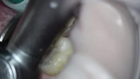 Dentistry. video filming under a microscope. removal of old filling and caries Stock Footage 162027798