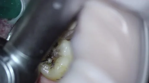 Dentistry. video filming under a microscope. removal of old filling and caries Stock Footage 162027836