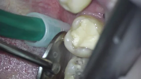 Dentistry. video filming under a microscope. removal of old filling and caries Stock Footage 162027876