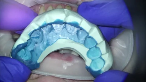 Dentistry. video filming under a microscope. obtaining the shape of the patient Stock Footage 162027911