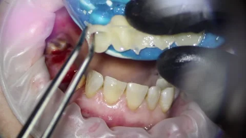 Dentistry. video filming under a microscope. fabrication of a plastic bridge Vidéo 162027974