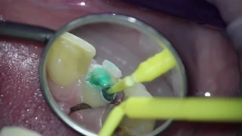 Dentistry. video filming under a microscope. applying caries marker on a Stock Footage 162028015