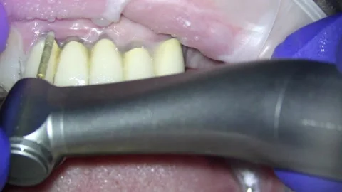 Dentistry. video filming under a microscope. removal of a ceramic tooth with a Stock Footage 162028127