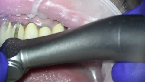 Dentistry. video filming under a microscope. removal of a ceramic tooth with a Stock Footage 162028267